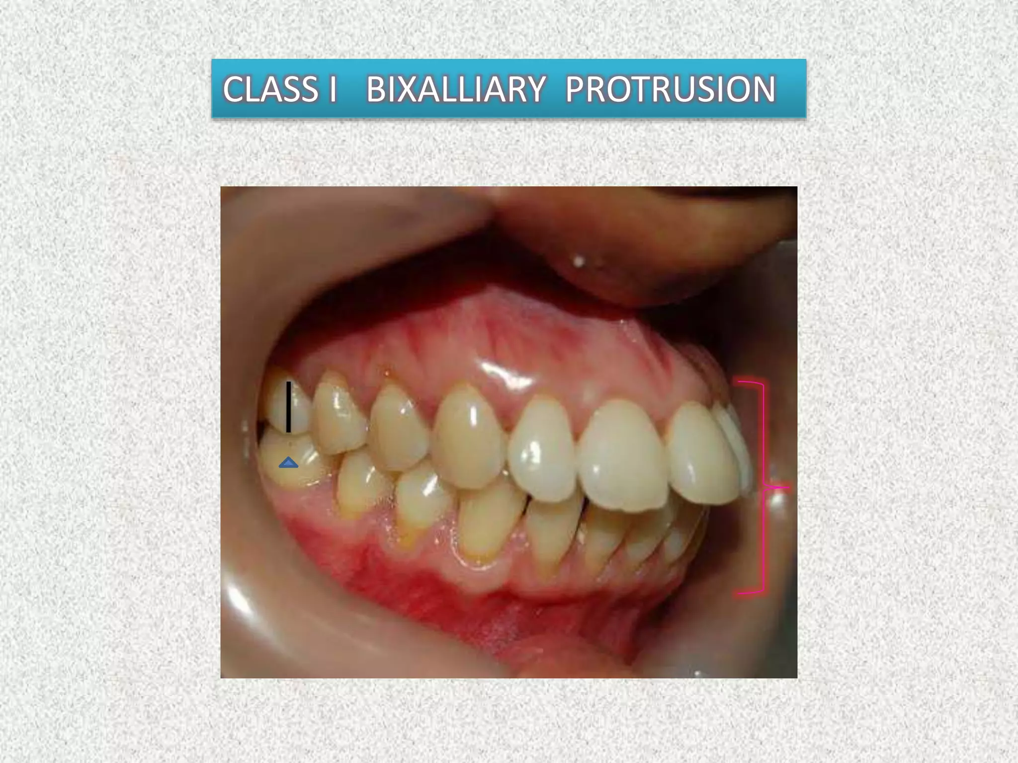 CLASS I BIXALLIARY PROTRUSION