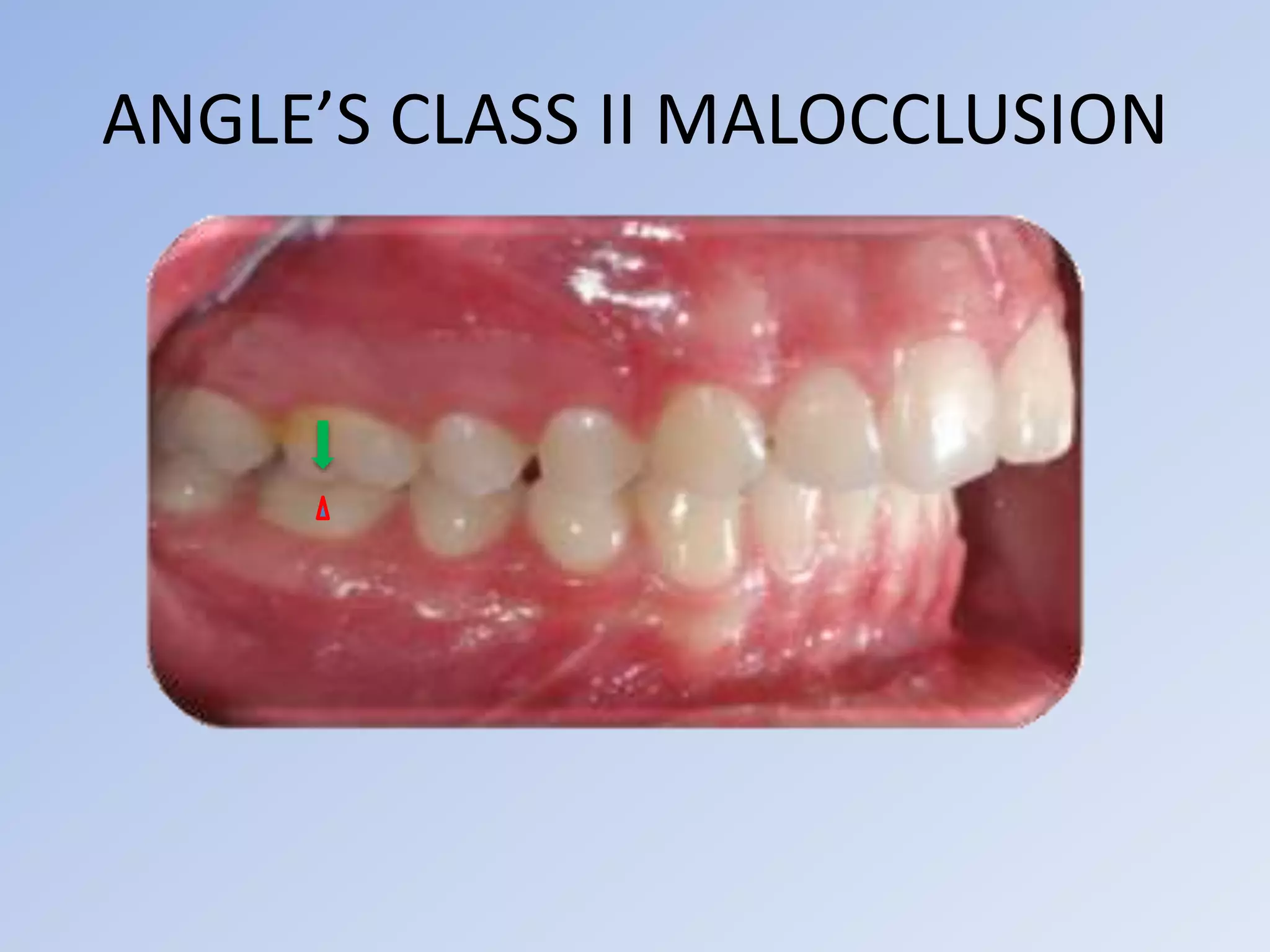 ANGLE’S CLASS II MALOCCLUSION