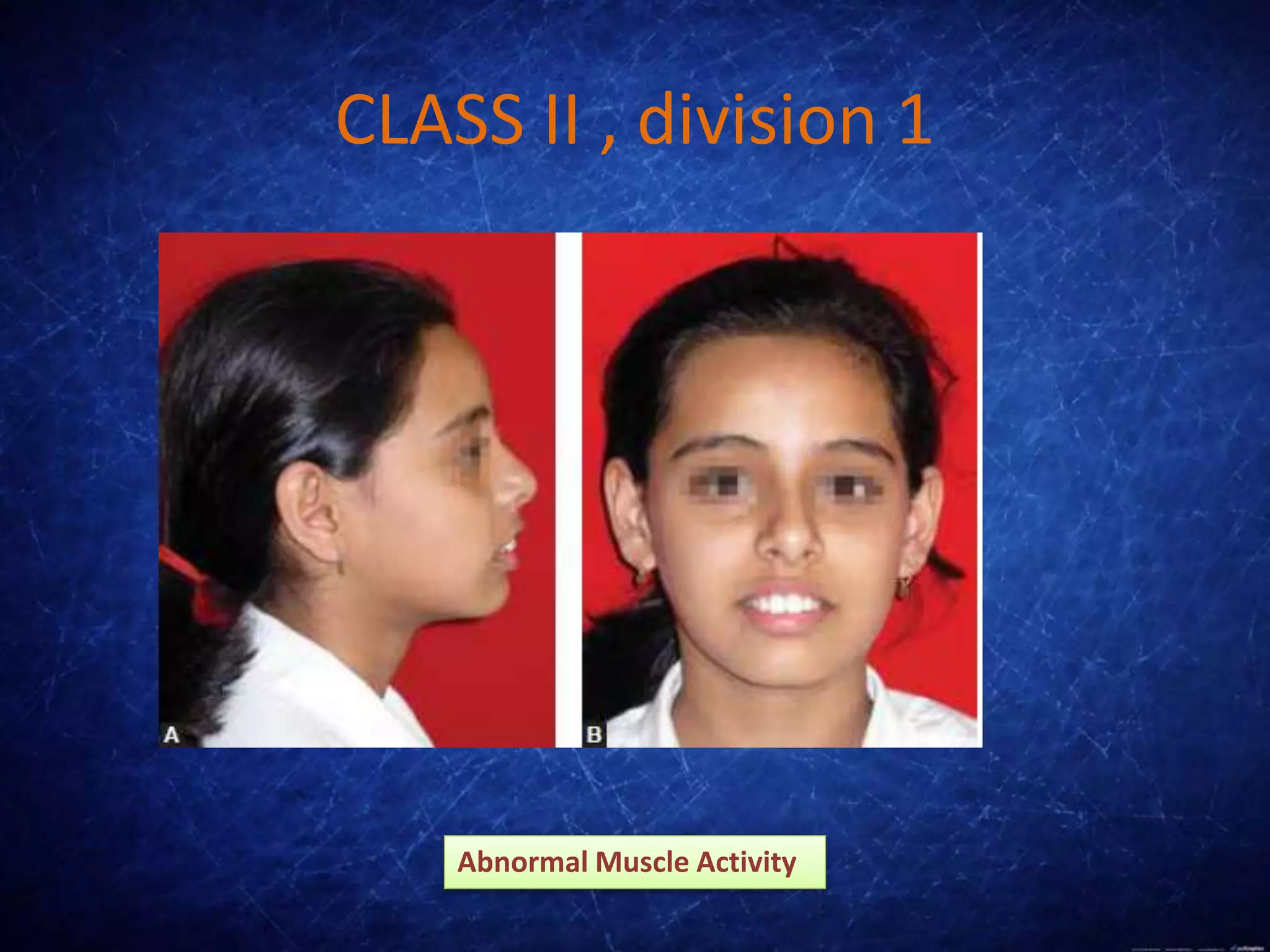 CLASS II , division 1
Abnormal Muscle Activity