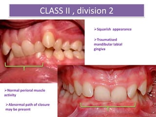 CLASS II , division 2
Squarish appearance
Traumatised
mandibular labial
gingiva
Normal perioral muscle
activity
Abnormal path of closure
may be present
 