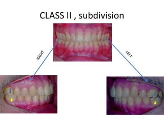 CLASS II , subdivision
 