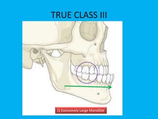 1) Excessively Large Mandible
TRUE CLASS III
 