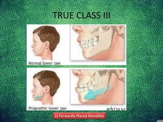 2) Forwardly Placed Mandible
TRUE CLASS III
 