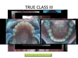 4) Smaller than Normal Maxilla
TRUE CLASS III
 