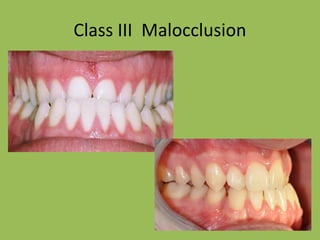 Class III Malocclusion
 