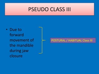 • Due to
forward
movement of
the mandible
during jaw
closure
POSTURAL / HABITUAL Class III
PSEUDO CLASS III
 