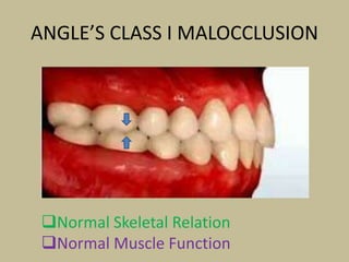 ANGLE’S CLASS I MALOCCLUSION
Normal Skeletal Relation
Normal Muscle Function
 