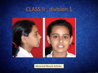 CLASS II , division 1
Abnormal Muscle Activity
 