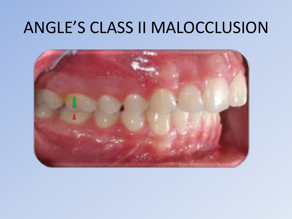 Angle's classification of malocclusion