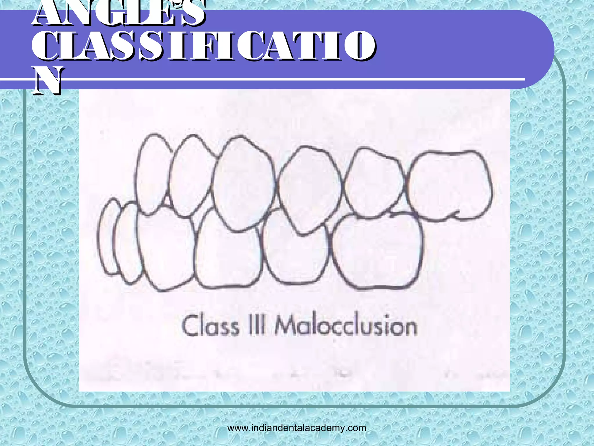 Angles classification /certified fixed orthodontic courses by Indian ...