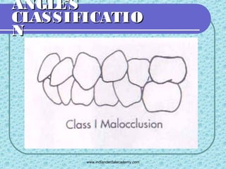 Angles classification /certified fixed orthodontic courses by Indian ...