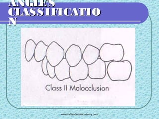 Angles classification & its shortcoming 2 | PPT