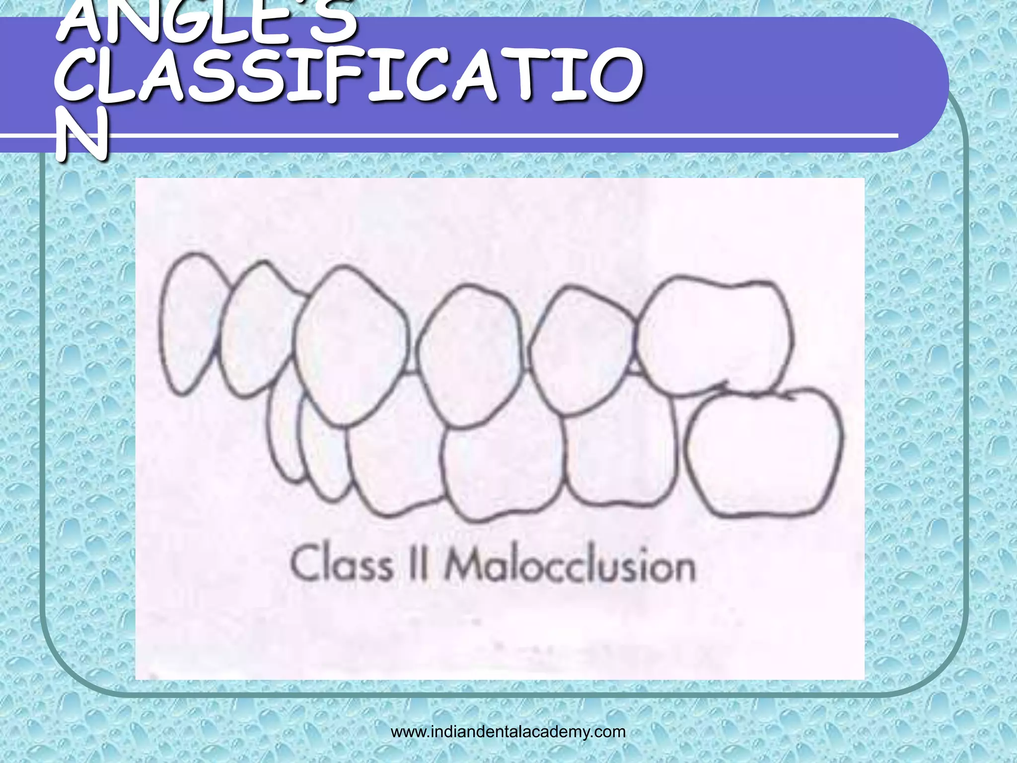 Angles classification & its shortcoming 2 /certified fixed orthodontic ...