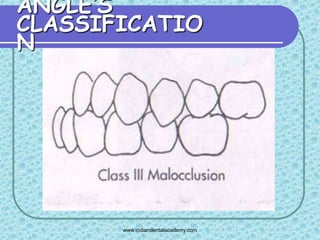 Angles classification & its shortcoming 2 /certified fixed orthodontic ...