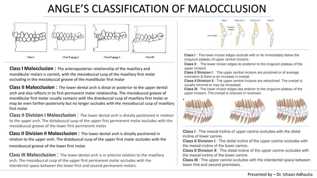 Angle's Classification Of Malocclusion | PDF | Dental Health | Diseases ...