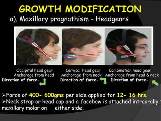 GROWTH MODIFICATION
a). Maxillary prognathism - Headgears
Occipital head gear Cervical head gear Combination head gear
Anchorage from head Anchorage from neck Anchorage from head & neck
Direction of force- Direction of force- Direction of force-
Force of 400- 600gms per side applied for 12- 16 hrs.
Neck strap or head cap and a facebow is attached intraorally t
maxillary molar on either side.
 