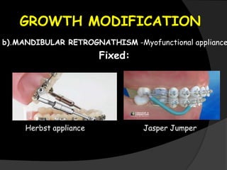 GROWTH MODIFICATION
b).MANDIBULAR RETROGNATHISM -Myofunctional appliance
Fixed:
Herbst appliance Jasper Jumper
 