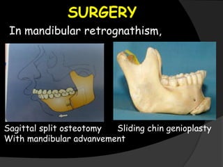 SURGERY
In mandibular retrognathism,
Sagittal split osteotomy Sliding chin genioplasty
With mandibular advanvement
 