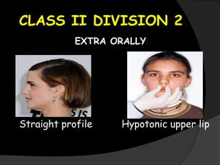 CLASS II DIVISION 2
EXTRA ORALLY
Straight profile Hypotonic upper lip
 
