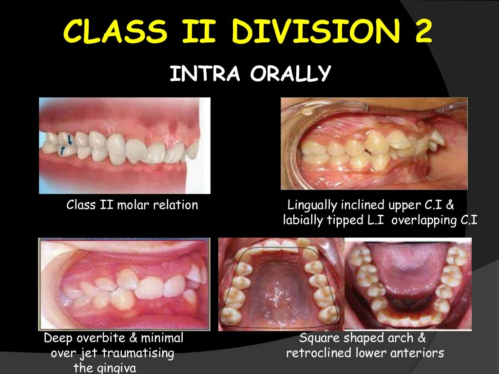 Angle’s class ii malocclusion