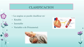 CLASIFICACION
• La angina se puede clasificar en:
• Estable
• Inestable
• Variable o de Prinzmetal.
 