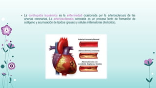 • La cardiopatía isquémica es la enfermedad ocasionada por la arteriosclerosis de las
arterias coronarias, La arteriosclerosis coronaria es un proceso lento de formación de
colágeno y acumulación de lípidos (grasas) y células inflamatorias (linfocitos).
 