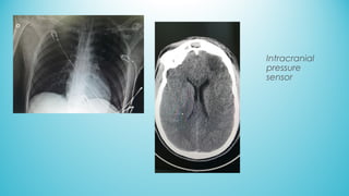 Intracranial
pressure
sensor
 