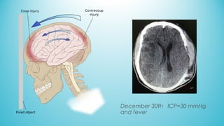 December 30th ICP=30 mmHg
and fever
 