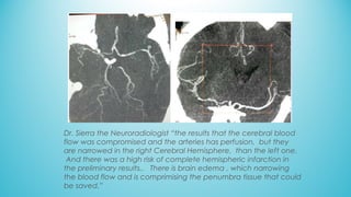 Dr. Sierra the Neuroradiologist “the results that the cerebral blood
flow was compromised and the arteries has perfusion,  but they
are narrowed in the right Cerebral Hemisphere,  than the left one.
 And there was a high risk of complete hemispheric infarction in
the preliminary results..   There is brain edema , which narrowing
the blood flow and is comprimising the penumbra tissue that could
be saved.”
 