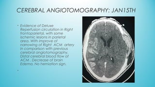 CEREBRAL ANGIOTOMOGRAPHY: JAN15TH
• Evidence of Deluxe
Reperfusion circulation in Right
frontoparietal, with some
ischemic lesions in parietal
area. With improve of
narrowing of Right  ACM  artery
in comparison with previous
cerebral angiotomography.
Distal cerebral blood flow of
ACM . Decrease of brain
Edema. No herniation sign.
•
 