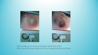 With evidence of mucous plug left distal bronchial.
After bronchoscopy improve of both segmentals bronchioles.
 