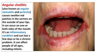 Angular chilitis | PPT