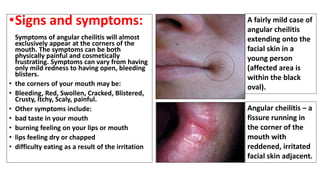 •Signs and symptoms:
Symptoms of angular cheilitis will almost
exclusively appear at the corners of the
mouth. The symptoms can be both
physically painful and cosmetically
frustrating. Symptoms can vary from having
only mild redness to having open, bleeding
blisters.
• the corners of your mouth may be:
• Bleeding, Red, Swollen, Cracked, Blistered,
Crusty, Itchy, Scaly, painful.
• Other symptoms include:
• bad taste in your mouth
• burning feeling on your lips or mouth
• lips feeling dry or chapped
• difficulty eating as a result of the irritation
A fairly mild case of
angular cheilitis
extending onto the
facial skin in a
young person
(affected area is
within the black
oval).
Angular cheilitis – a
fissure running in
the corner of the
mouth with
reddened, irritated
facial skin adjacent.
 