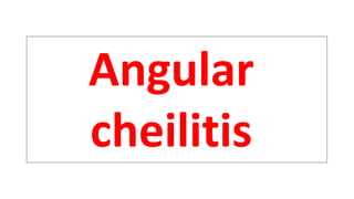 Angular
cheilitis
 