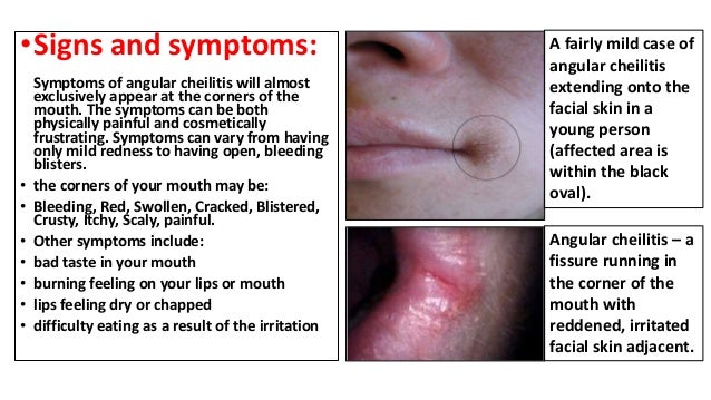 What Is Angular Cheilitis
