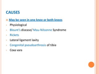 CAUSES
 May be seen in one knee or both knees
• Physiological
• Blount’s disease/ Mau-Nilsonne Syndrome
• Rickets
• Lateral ligament laxity
• Congenital pseudoarthrosis of tibia
• Coxa vara
 