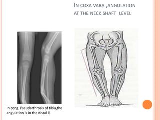 IN COXA VARA ,ANGULATION
AT THE NECK SHAFT LEVEL
In cong. Pseudarthrosis of tibia,the
angulation is in the distal ⅓
 