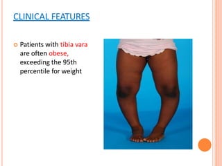 CLINICAL FEATURES
 Patients with tibia vara
are often obese,
exceeding the 95th
percentile for weight
 