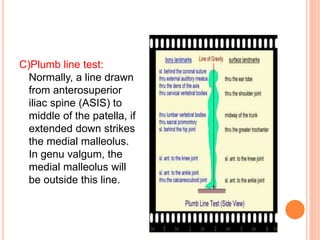 C)Plumb line test:
Normally, a line drawn
from anterosuperior
iliac spine (ASIS) to
middle of the patella, if
extended down strikes
the medial malleolus.
In genu valgum, the
medial malleolus will
be outside this line.
 