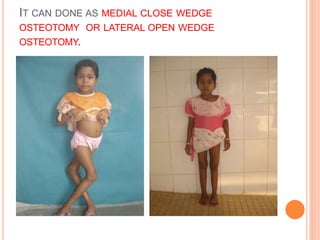 IT CAN DONE AS MEDIAL CLOSE WEDGE
OSTEOTOMY OR LATERAL OPEN WEDGE
OSTEOTOMY.
 