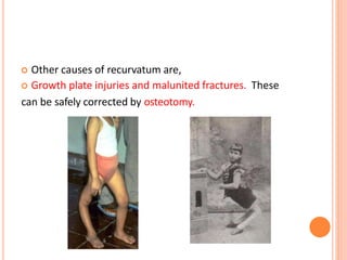  Other causes of recurvatum are,
 Growth plate injuries and malunited fractures. These
can be safely corrected by osteotomy.
 