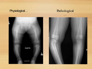Physiological…
Physiological… Pathological
…
 