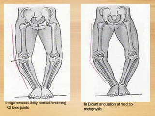In ligamentous laxity notelat.Widening
Of knee joints
In Blount angulation at med.tib
metaphysis
 