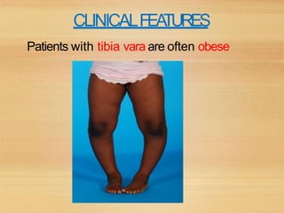 CLINICALFEATURES
Patients with tibia vara are often obese
 