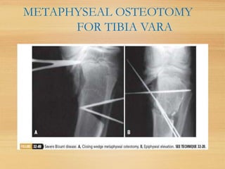 METAPHYSEAL OSTEOTOMY
FOR TIBIA VARA
 