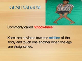 GENUVALGUM
Commonly called “knock-knee”
Kneesare deviated towards midline of the
body and touch one another when thelegs
are straightened.
 