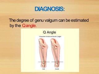 DIAGNOSIS:
Thedegree of genu valgum canbeestimated
by the Qangle.
 