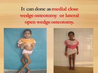 It can done asmedial close
wedgeosteotomy or lateral
open wedgeosteotomy.
 