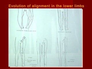 Angular & torsional deformities of the lower limb | PPT