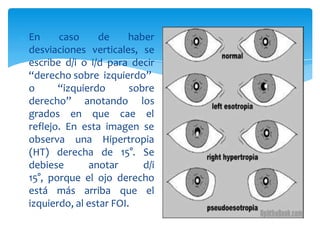 En caso de haber
desviaciones verticales, se
escribe d/i o i/d para decir
“derecho sobre izquierdo”
o “izquierdo
derecho” anotando
sobre
los
grados en que cae el
reflejo. En esta imagen se
observa una Hipertropia
debiese anotar
(HT) derecha de 15°. Se
d/i
15°, porque el ojo derecho
está más arriba que el
izquierdo, al estar FOI.
 